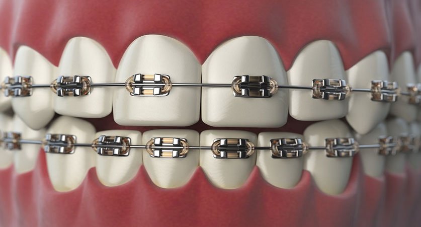 dental braces