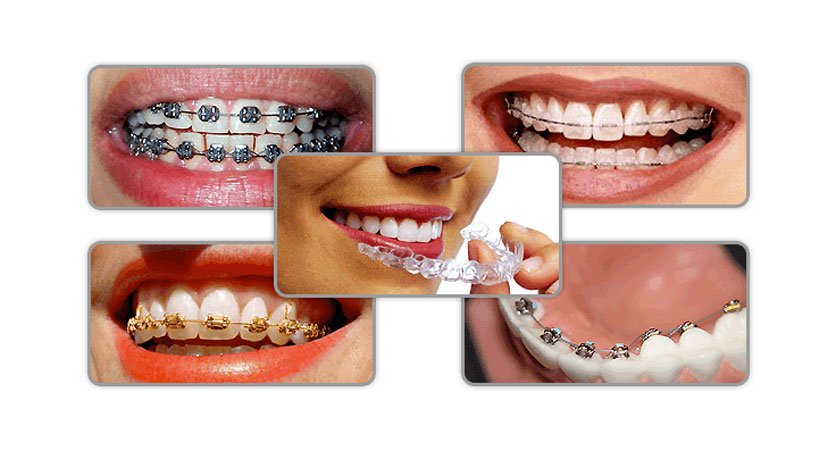 Types Of Braces