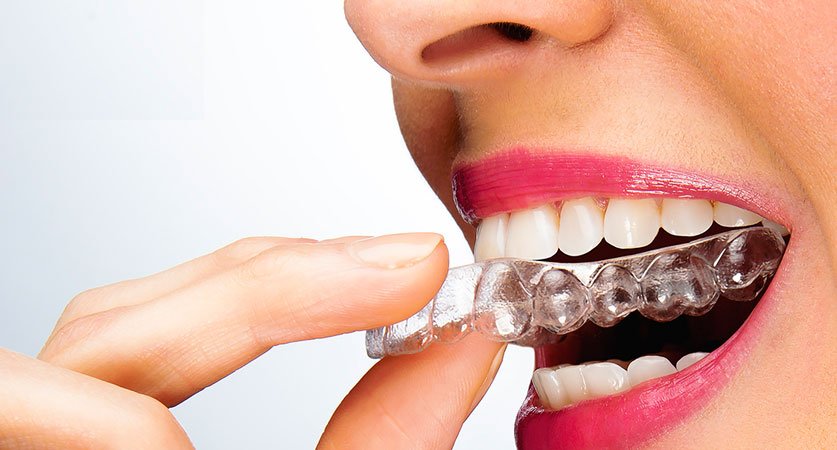 Invisalign locations