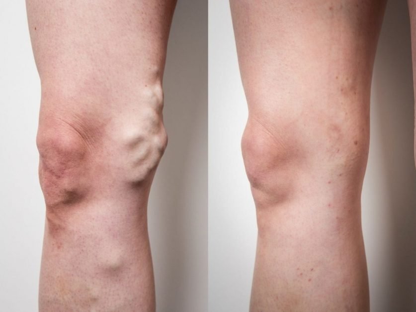 Varicose Veins Treatment