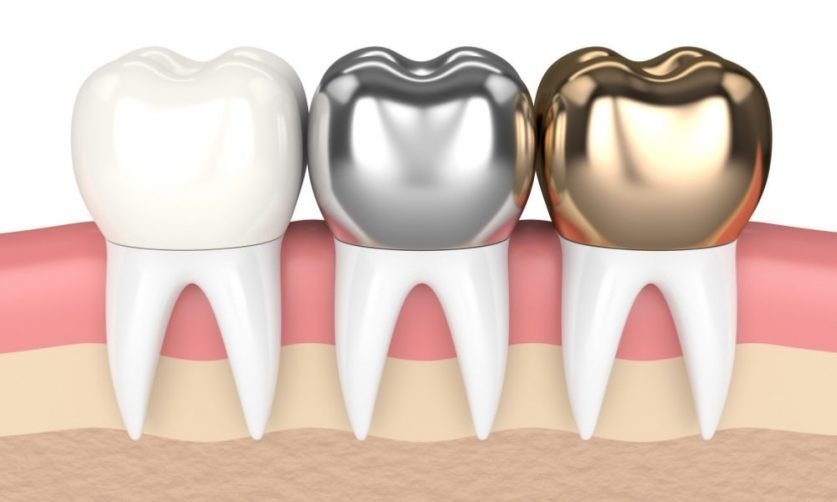 Dental Crowns