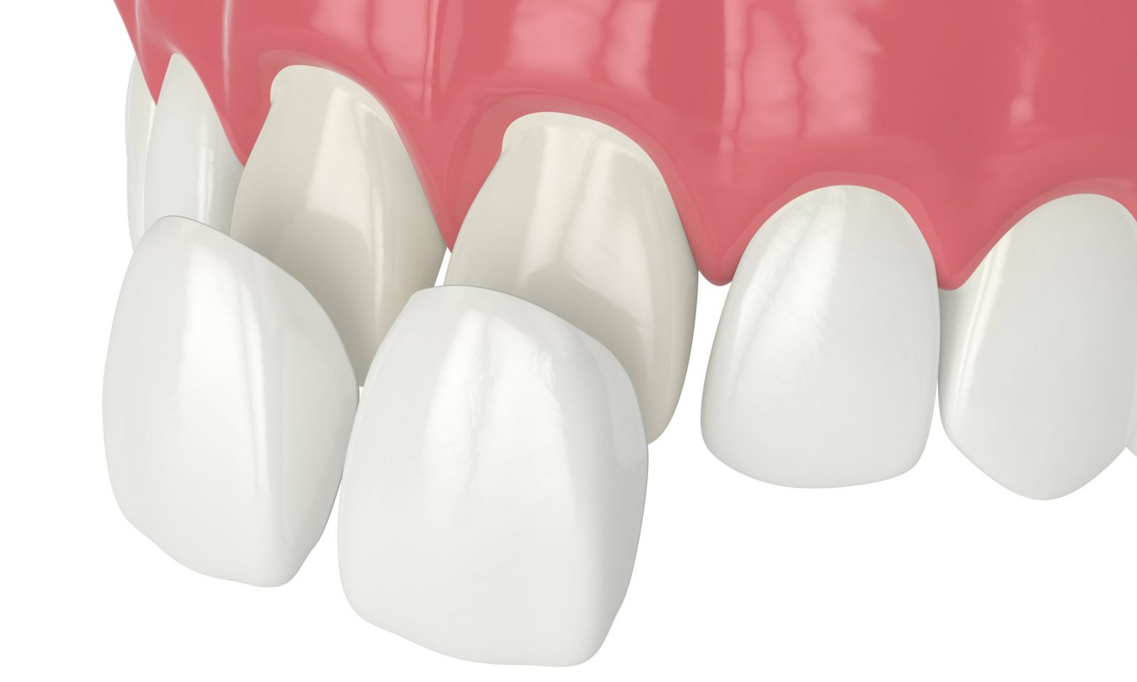 Dental Veneers