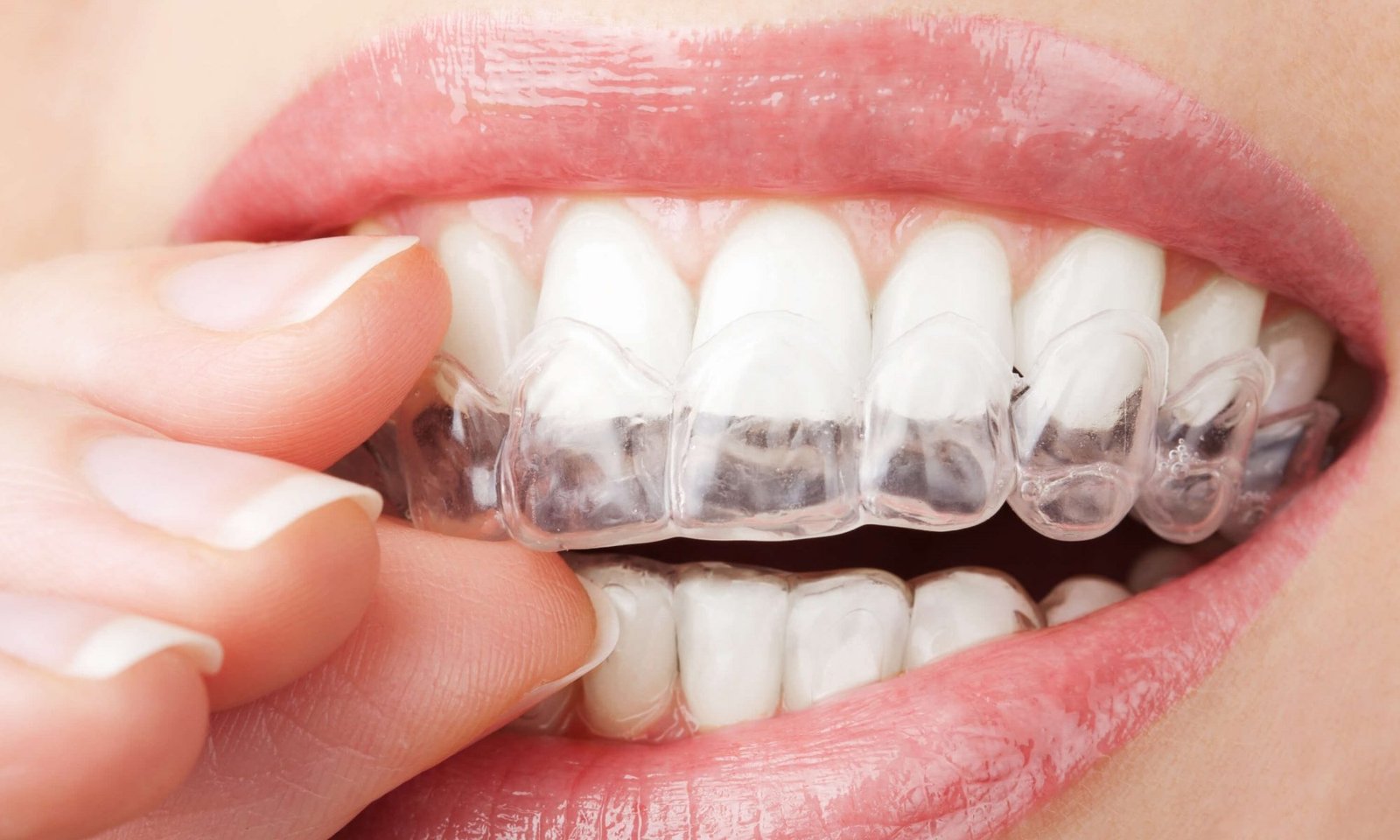 Invisalign