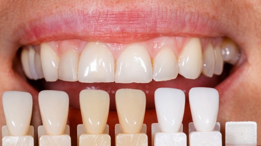 Porcelain Veneers