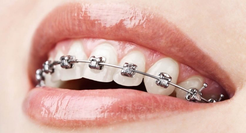 Metal Braces