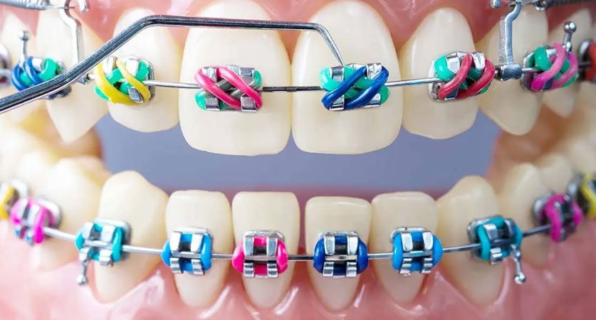 braces colors