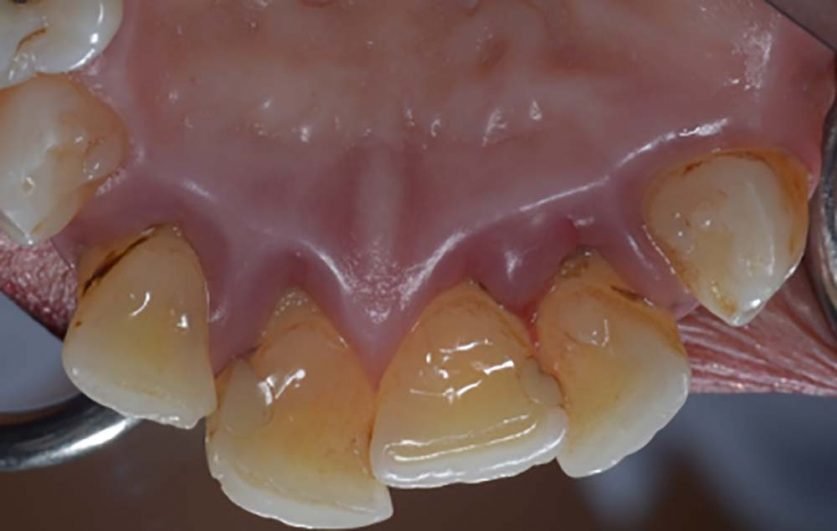 Periodontitis