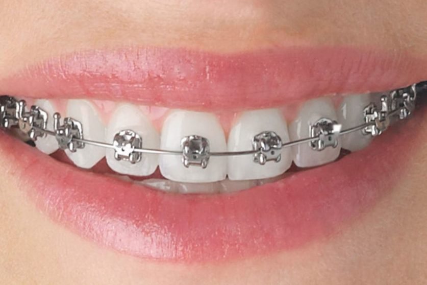 braces