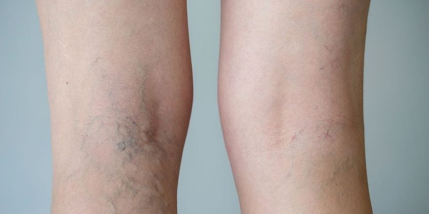 Do Spider Veins Come Back After Laser Treatment