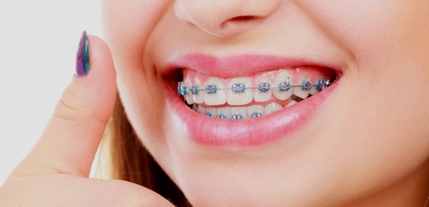 braces