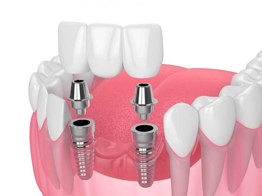 Dental Implant