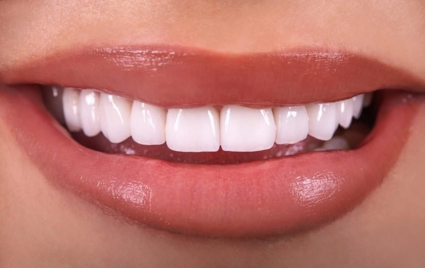 Veneers