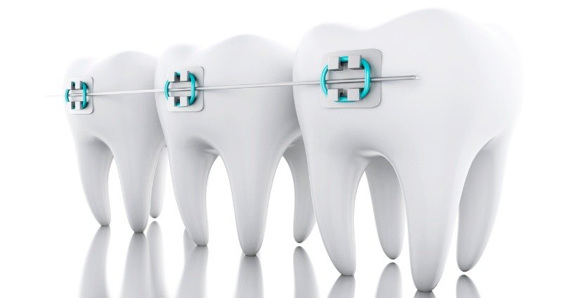 Dental Braces