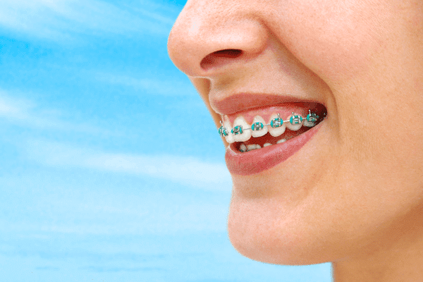 Blue Color Braces