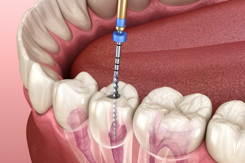 Root Canal Therapy