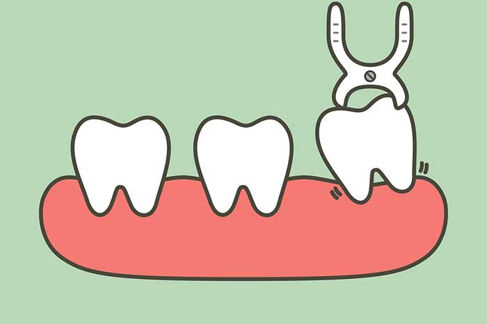Wisdom Teeth Removal