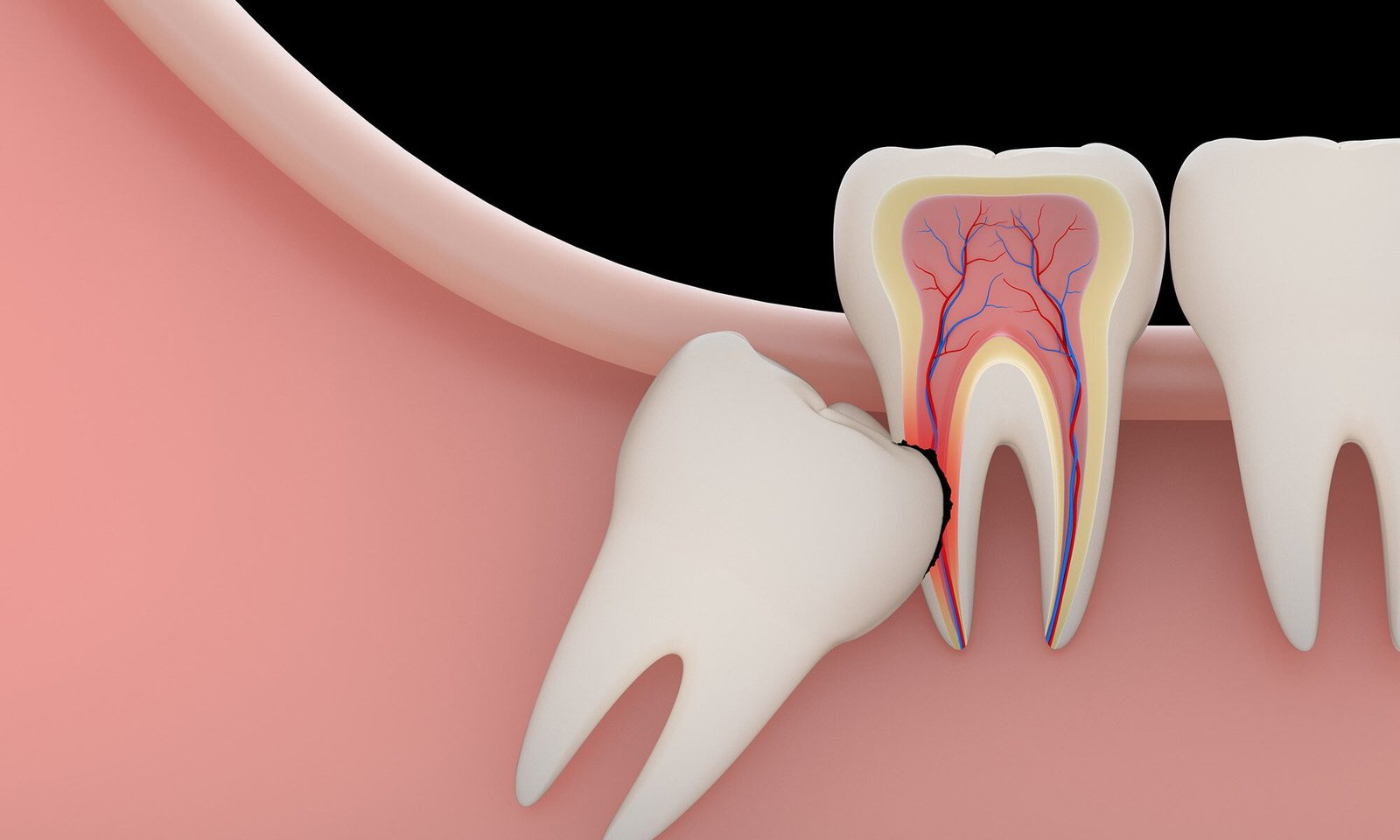 Wisdom Tooth Extraction