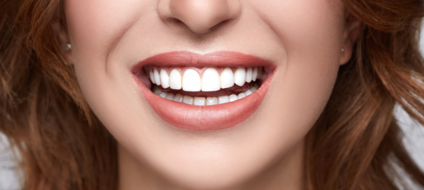 dental veneers