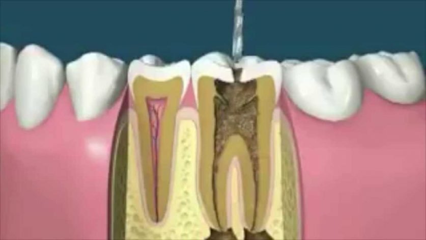 Root Canal Procedure